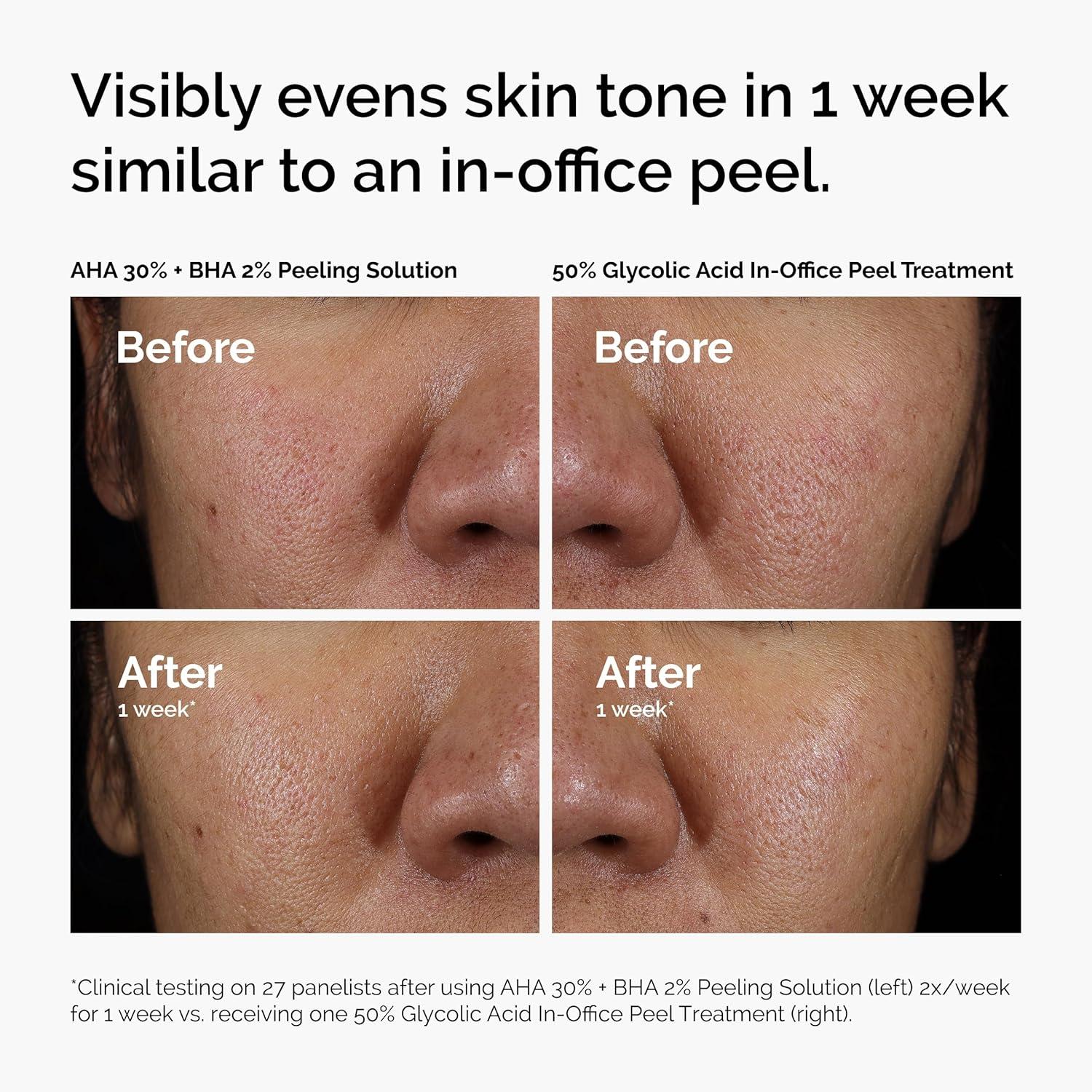 imageThe Ordinary AHA 30 BHA 2 Peeling Solution Advanced Exfoliating Peel for Brighter SkinBright Hydrated Serum Duo