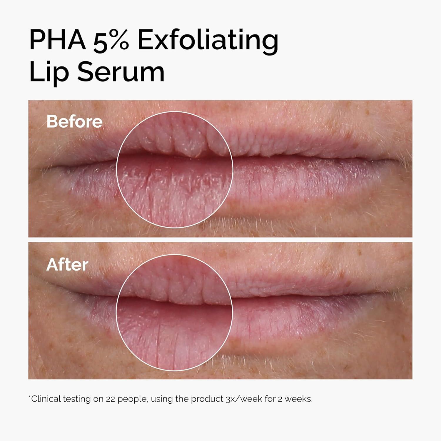 imageThe Ordinary PHA 5 Exfoliating Lip Serum Hydrating Overnight Lip Exfoliator Treatment 05 Fl Oz